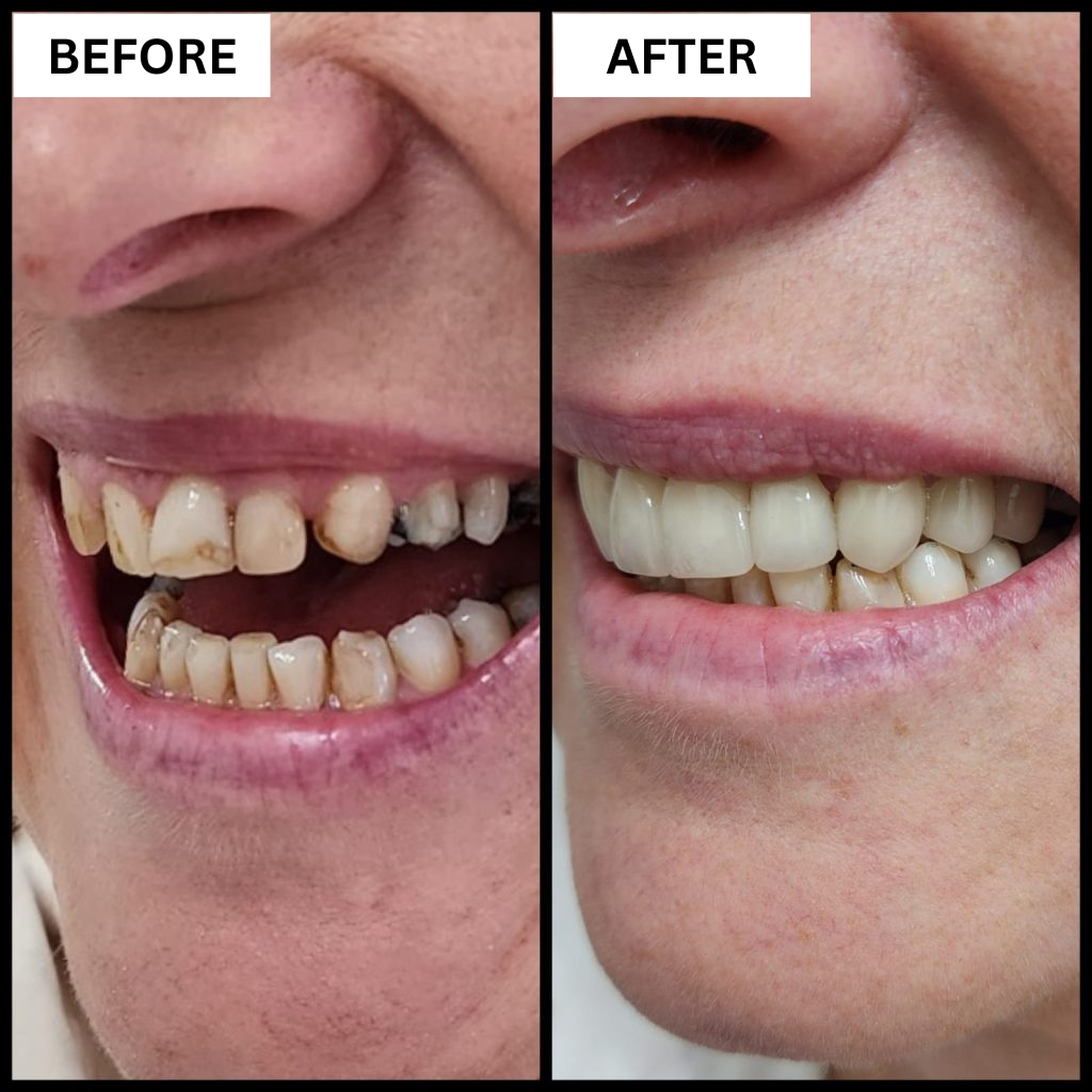 Before and after dental restoration result
