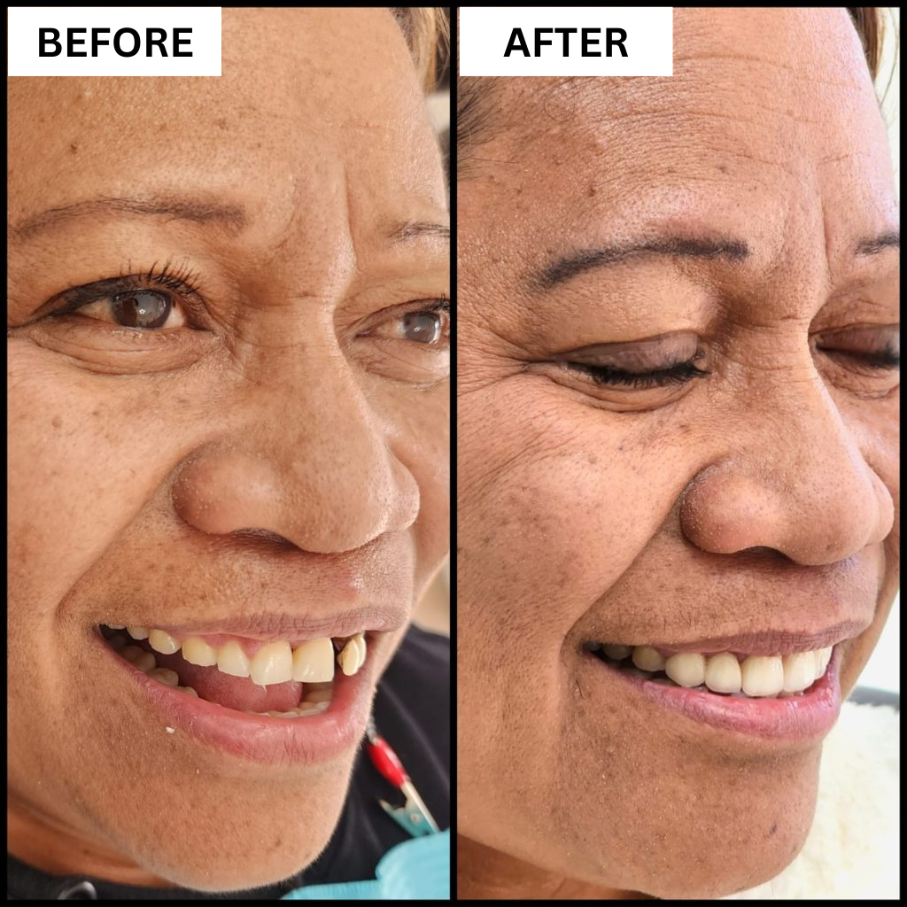 Before and after smile makeover result