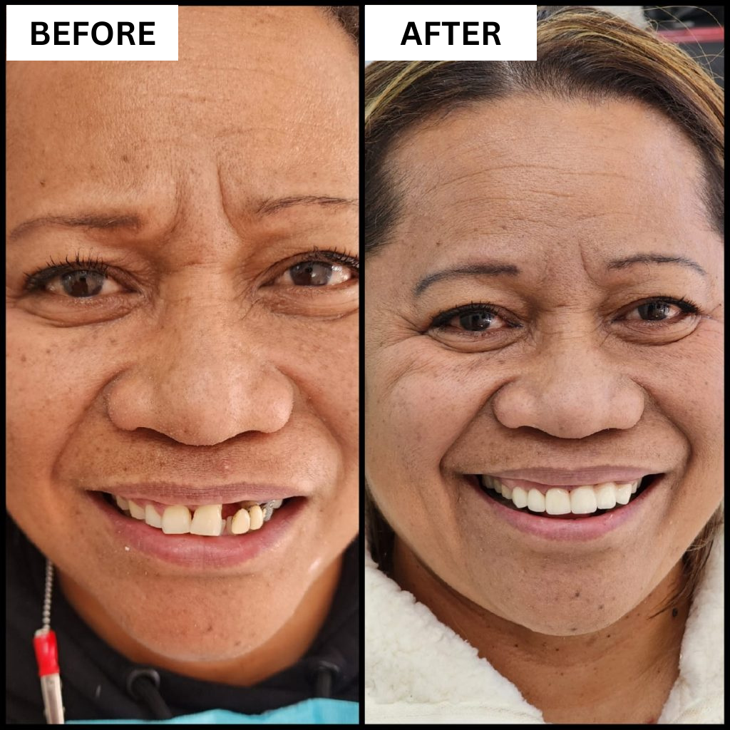 Before and after full smile result